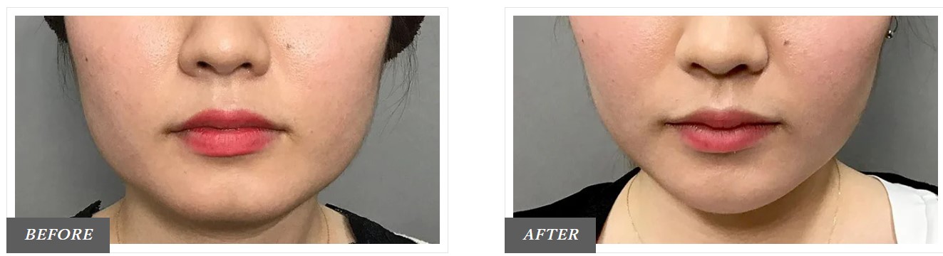 era-botox_beforeafter_TCB