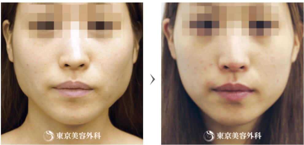 erabotox_beforeafter_tokyobiyou