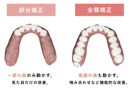 全顎矯正と部分矯正の比較