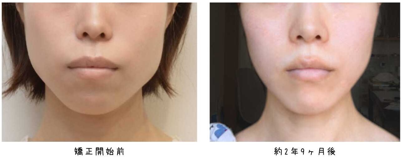 philtrum_compare