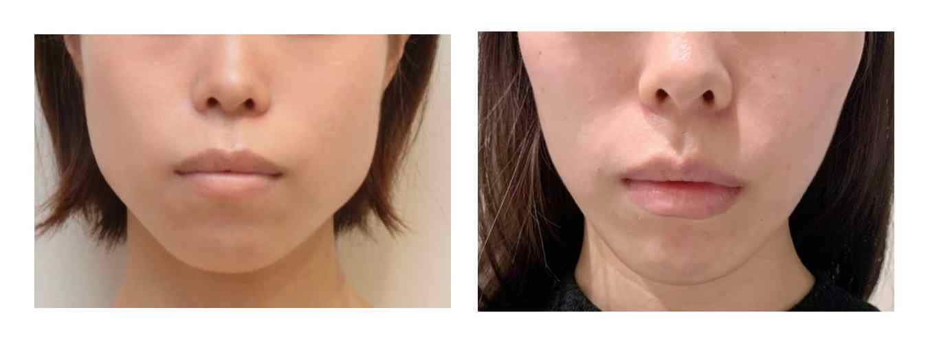 hollow-cheeks-before-after