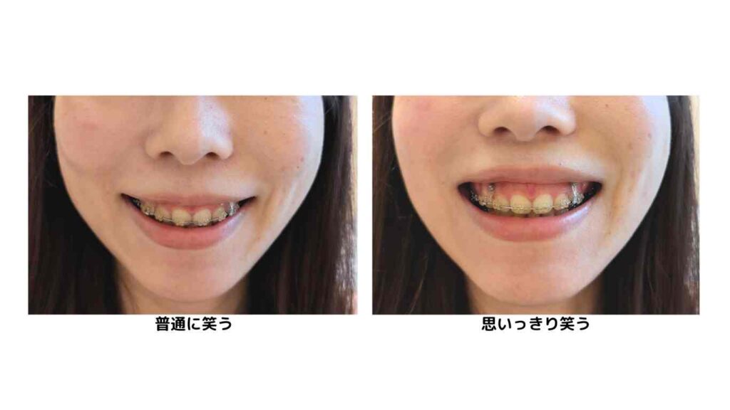 gummy-smile_orthodontics