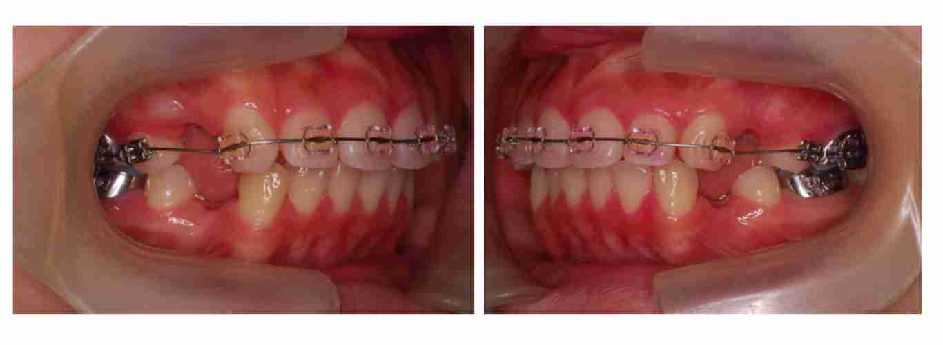 hollow-cheeks-tooth-extraction