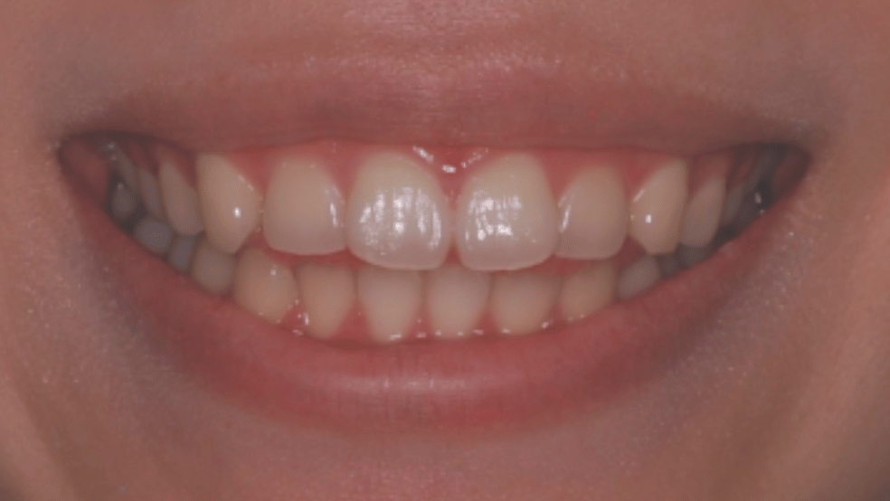 before-orthodontics